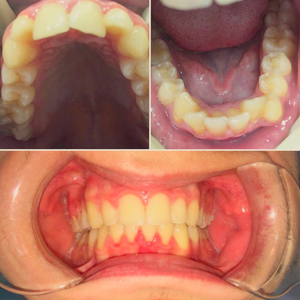 Проблема: Ортодонтическое лечение зубов на брекет-системе Damon Q