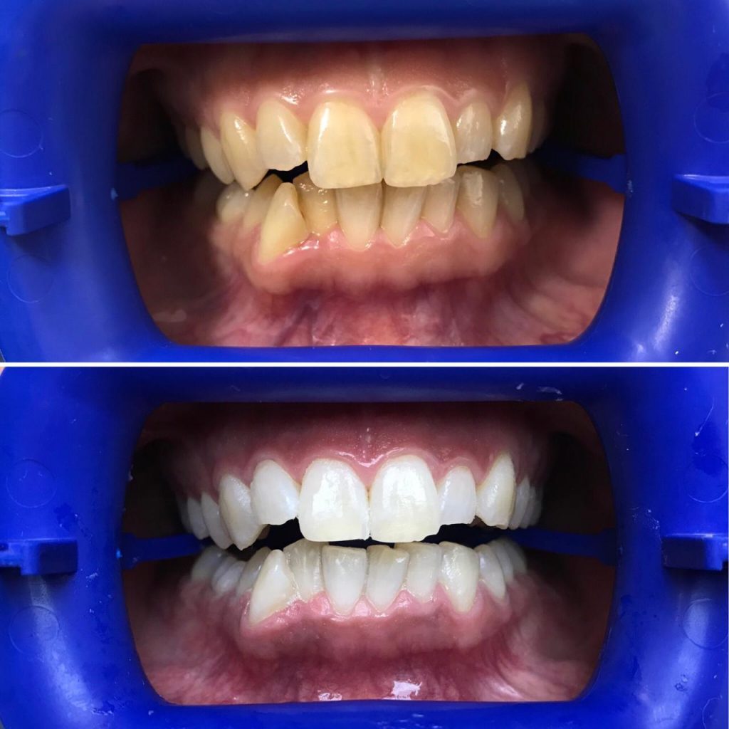 отбеливание зубов zoom 5 до и после
