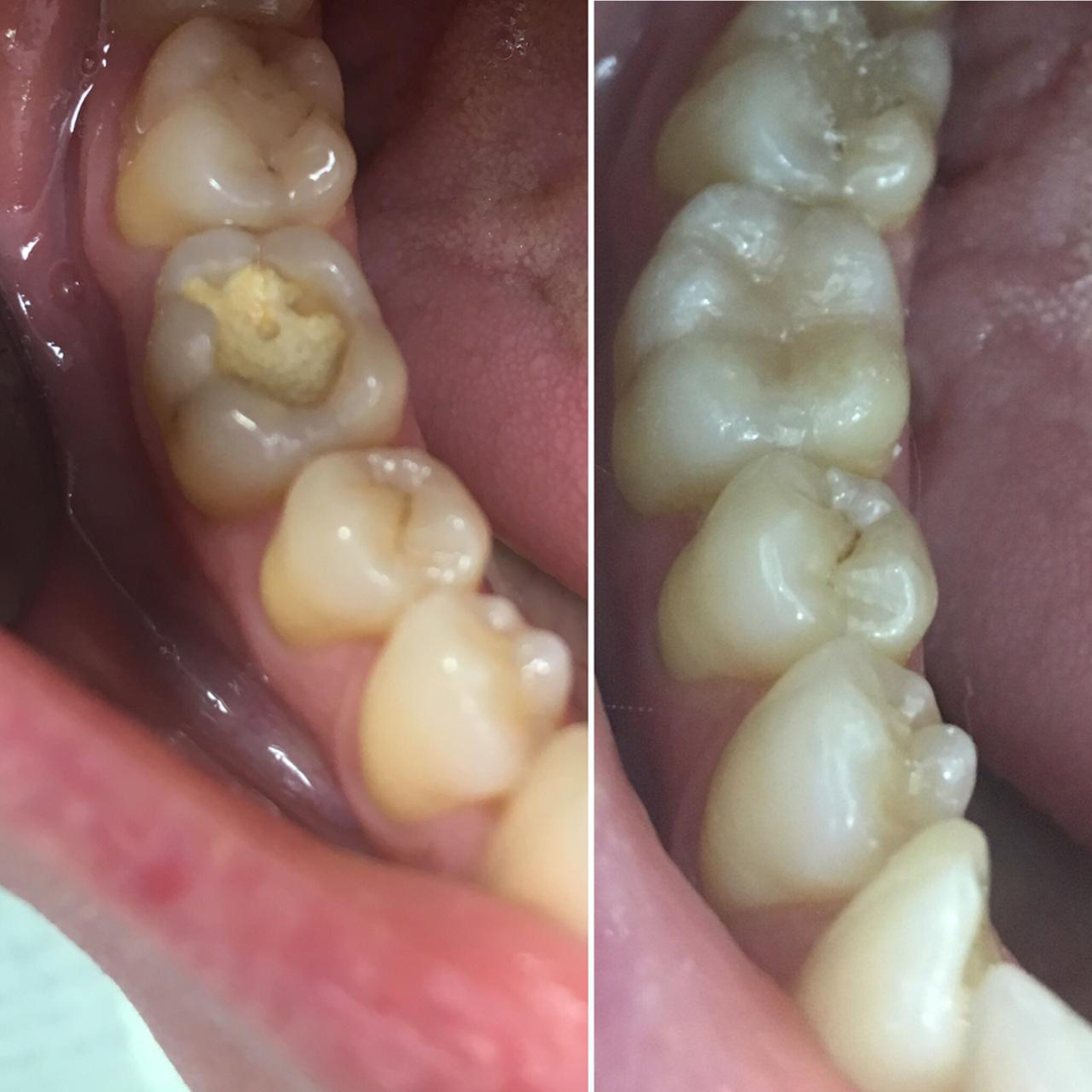 Проблема: Восстановление коронковой части зуба реставрационным материалом Estelaite