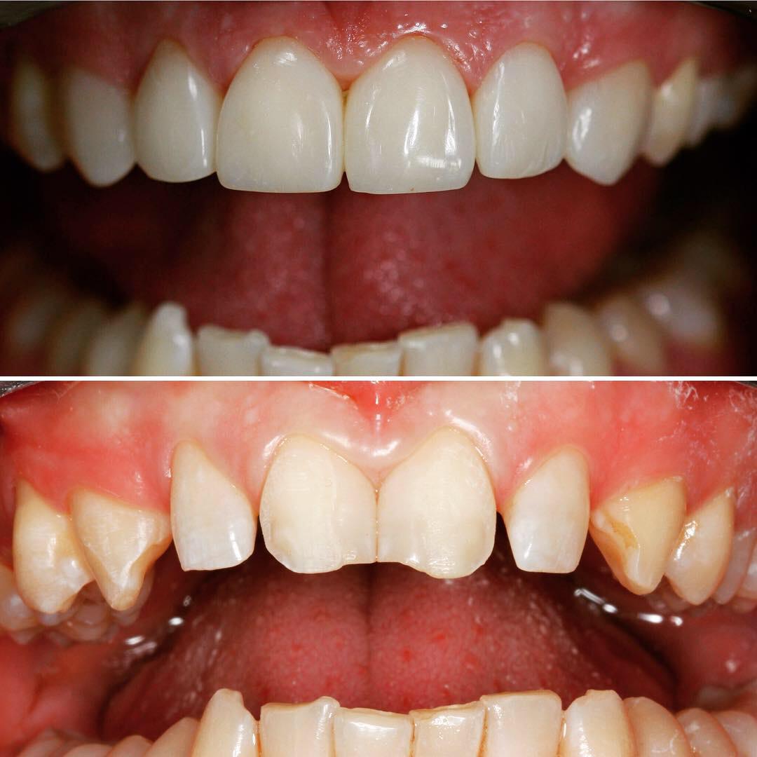 Проблема: Художественная реставрация передних зубов, зона улыбки. Работа доктора Шевцова П.Н.
